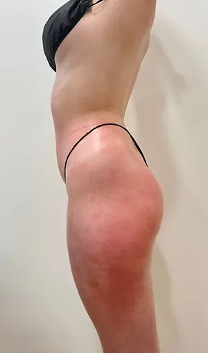 body sculpting, after — result 2