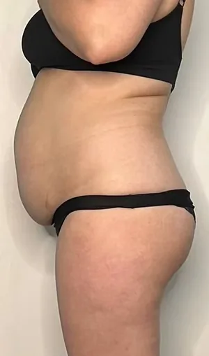 body sculpting, before — result 3